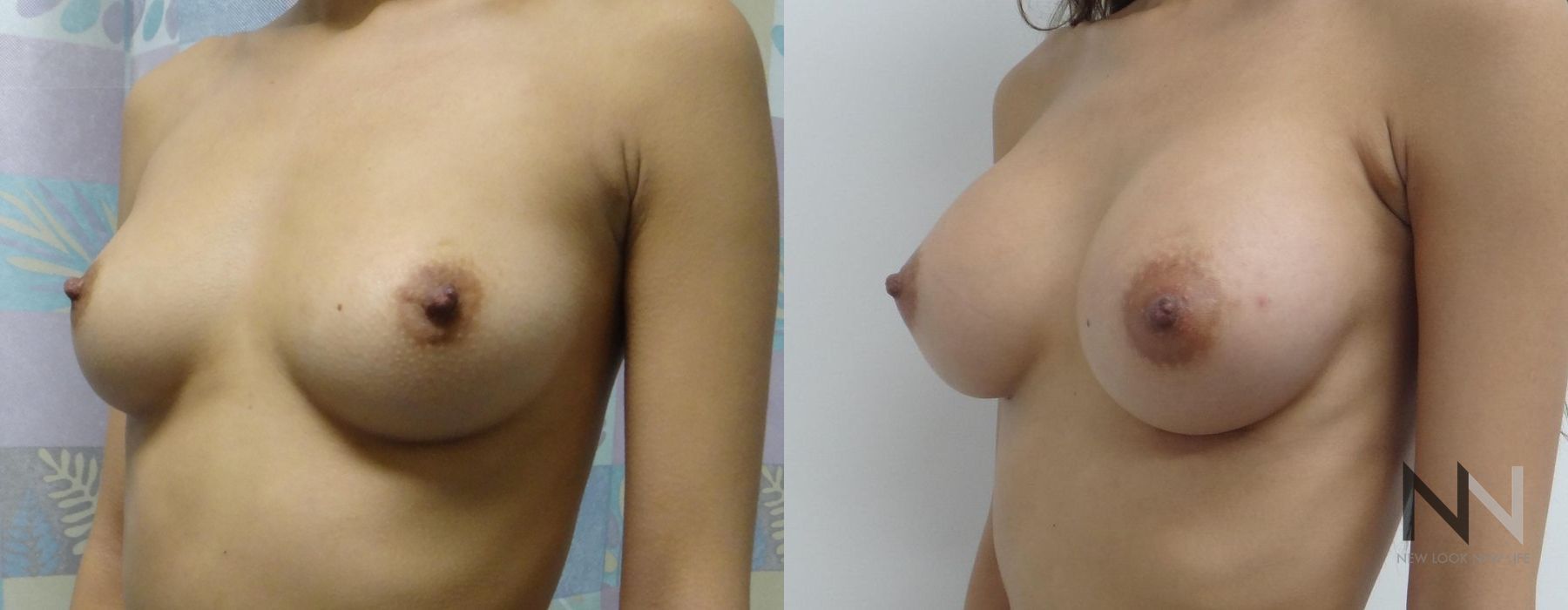 Breast Augmentation - Thumbnail 2