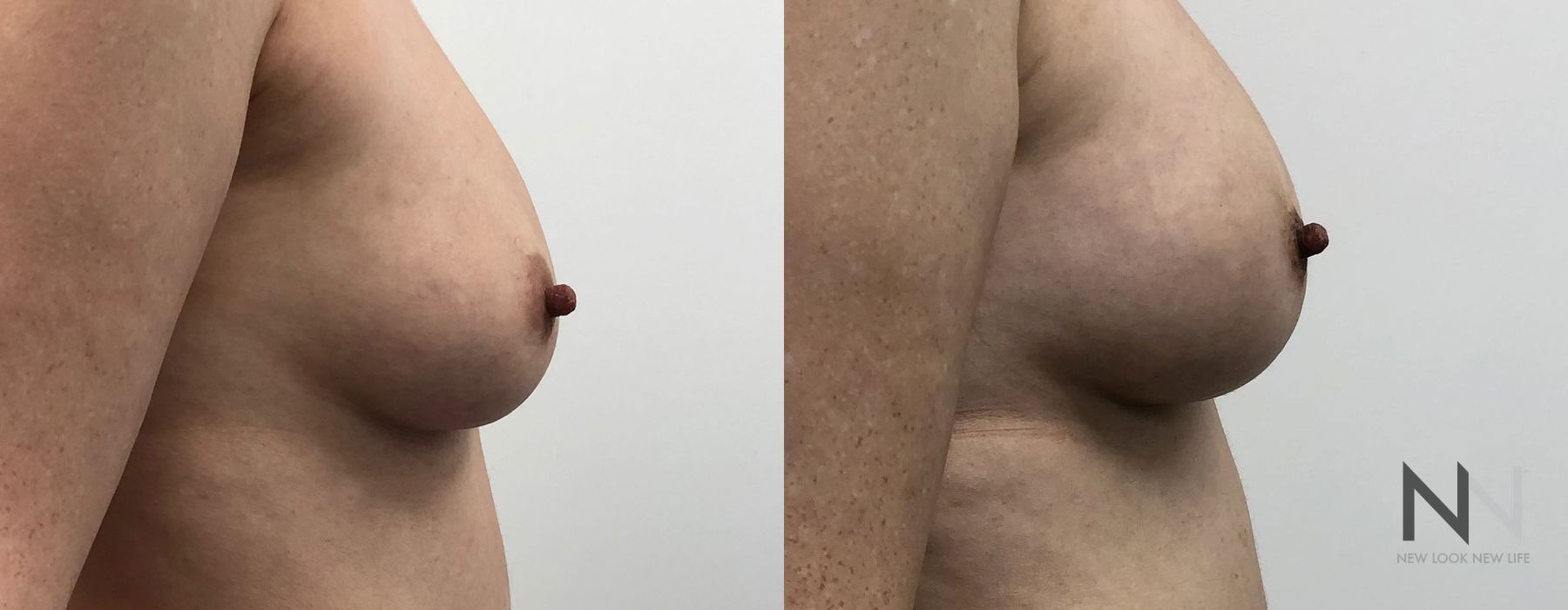 Breast Augmentation - Thumbnail 2