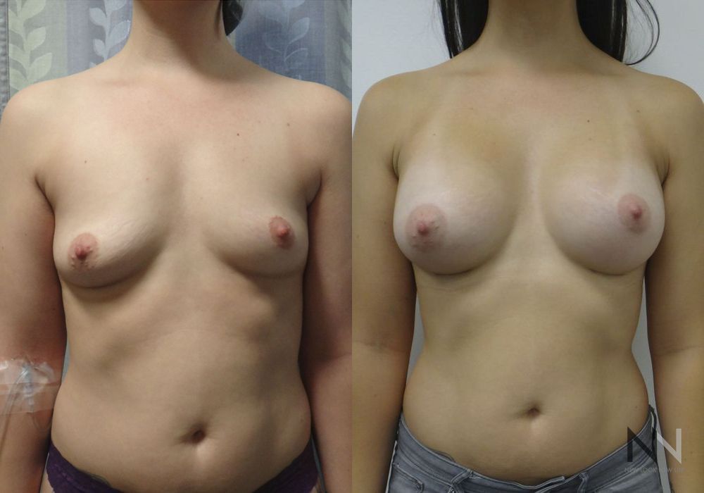 Breast Augmentation - Case 2003