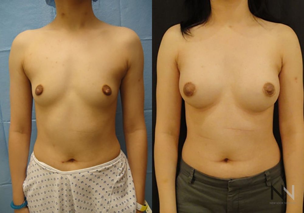 Breast Augmentation - Case 1806