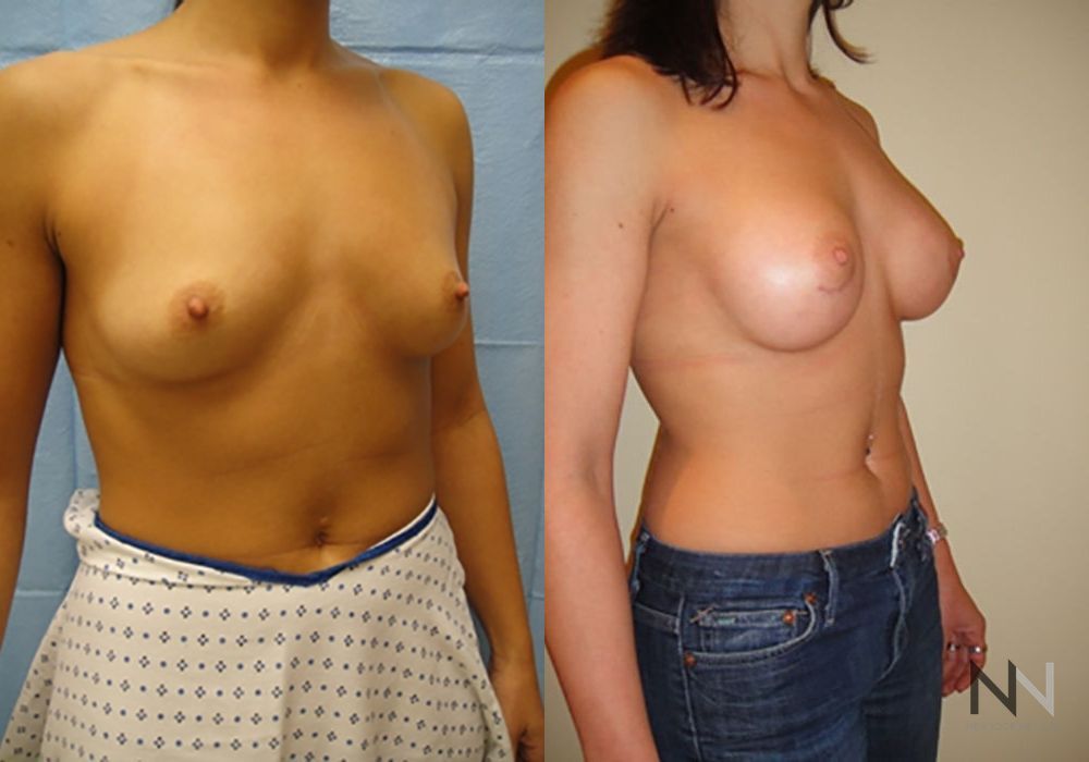 Breast Augmentation - Thumbnail 5