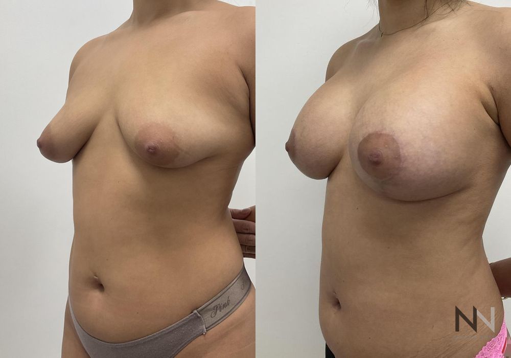 Breast Augmentation - Thumbnail 5