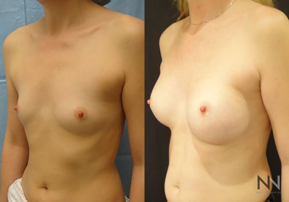 Breast Augmentation - Thumbnail 2