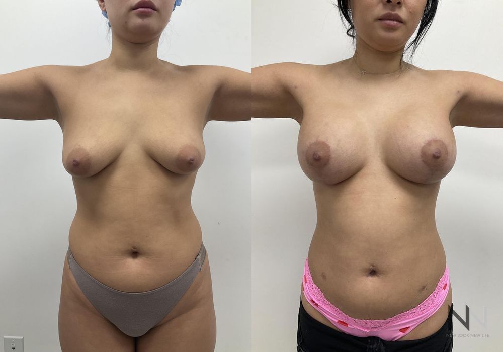Breast Augmentation - Thumbnail 2