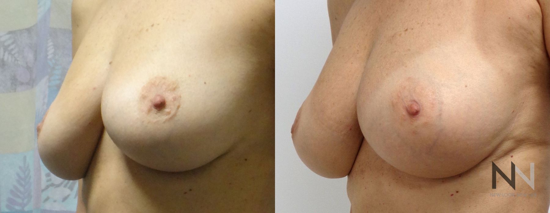 Breast Augmentation - Case 1830