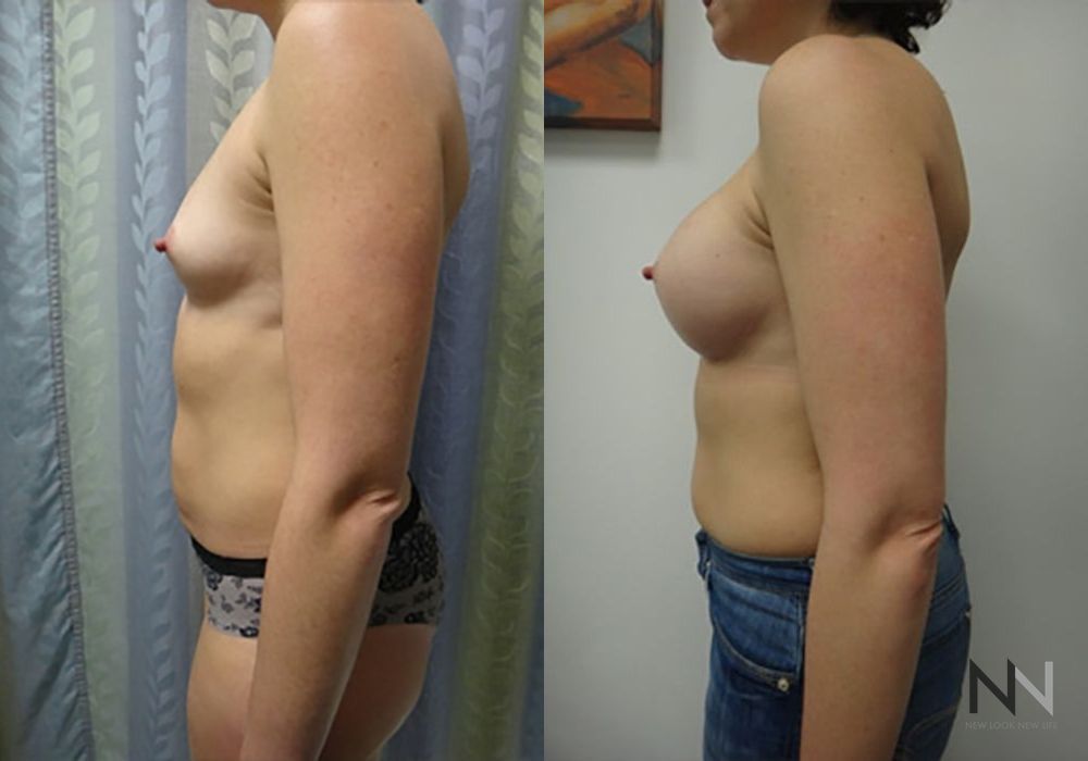 Breast Augmentation - Thumbnail 4