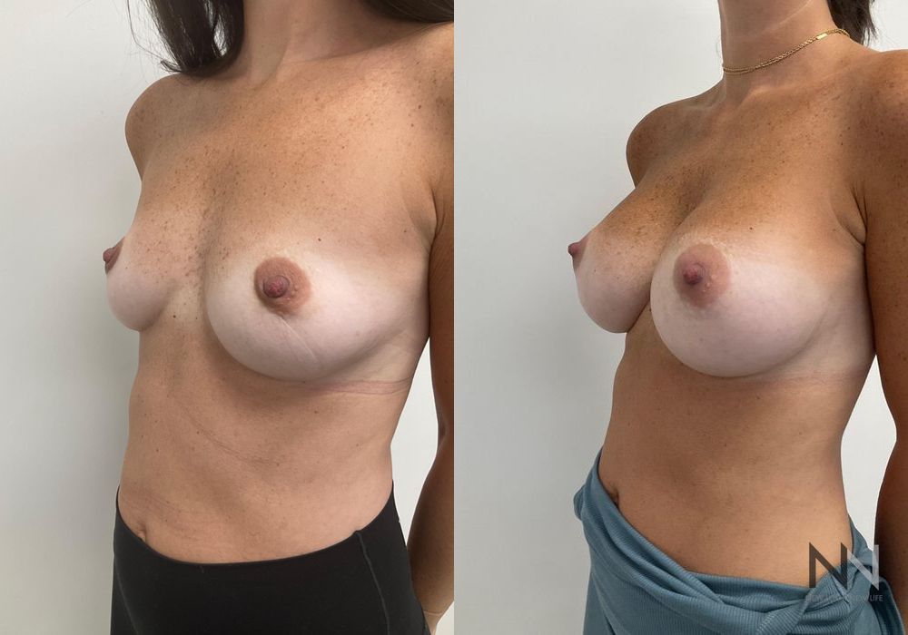 Breast Augmentation - Thumbnail 3