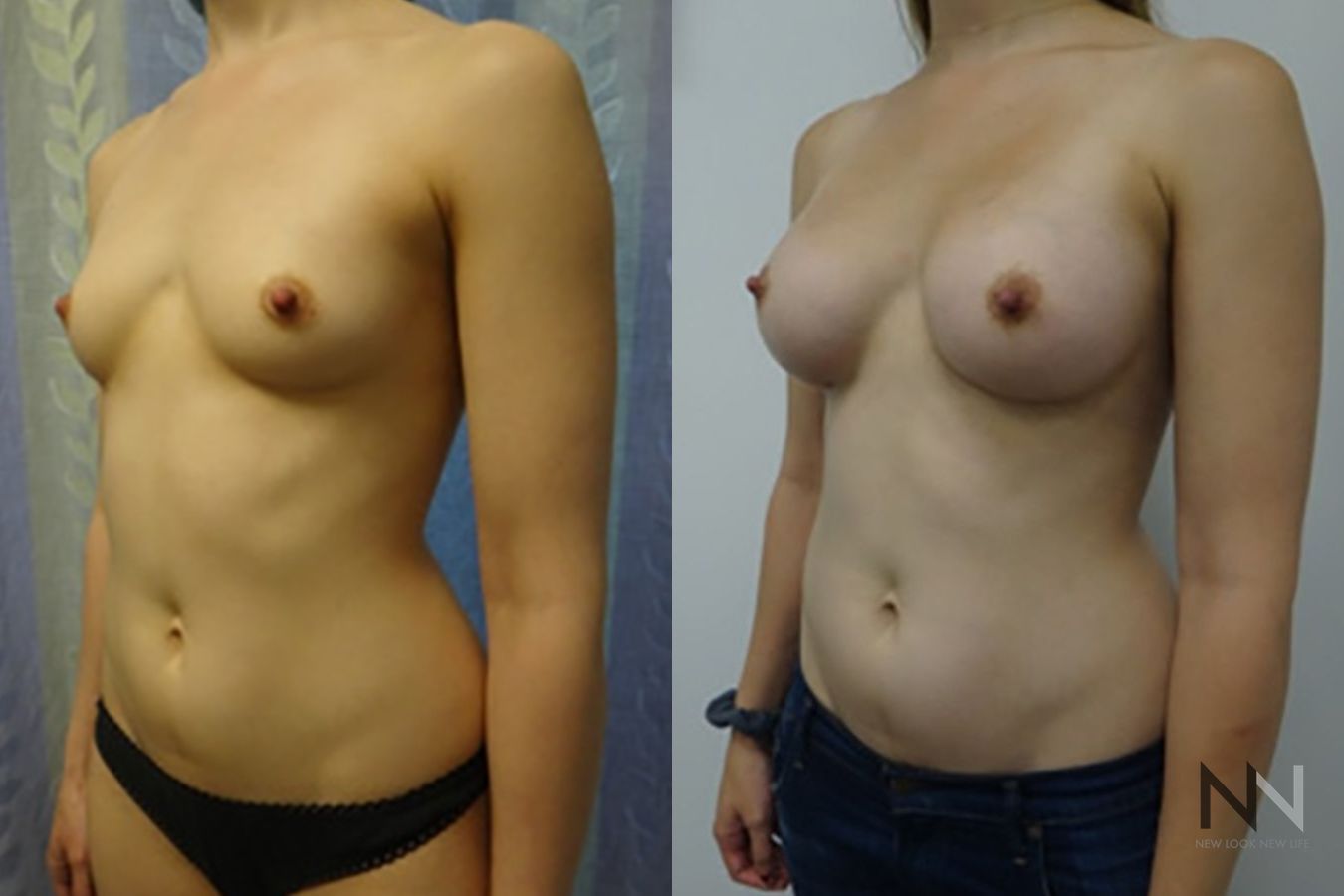 Before and after breast augmentation six months results - Angle 2
