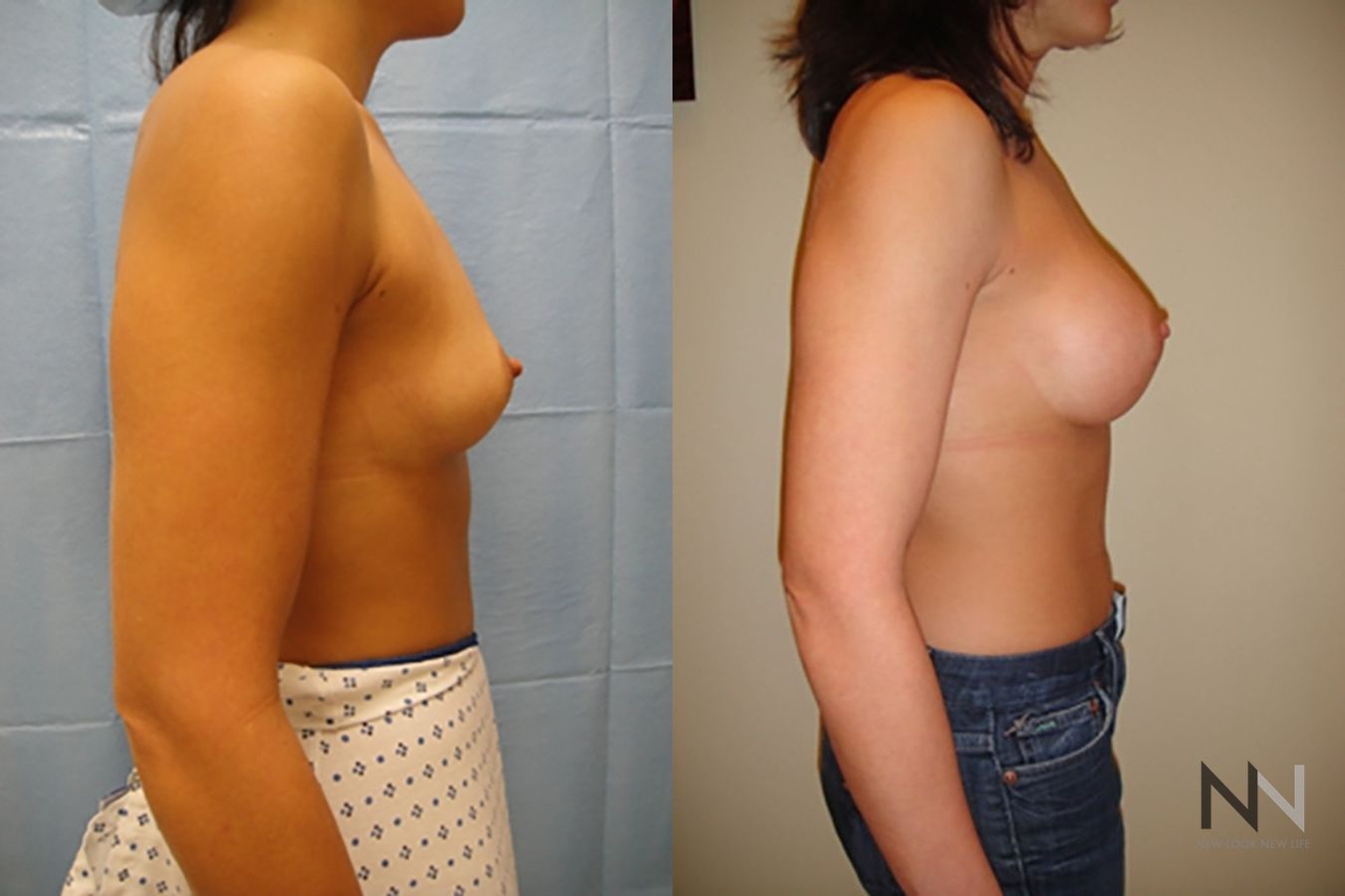 Breast contour enhancement six months post-op - Angle 5
