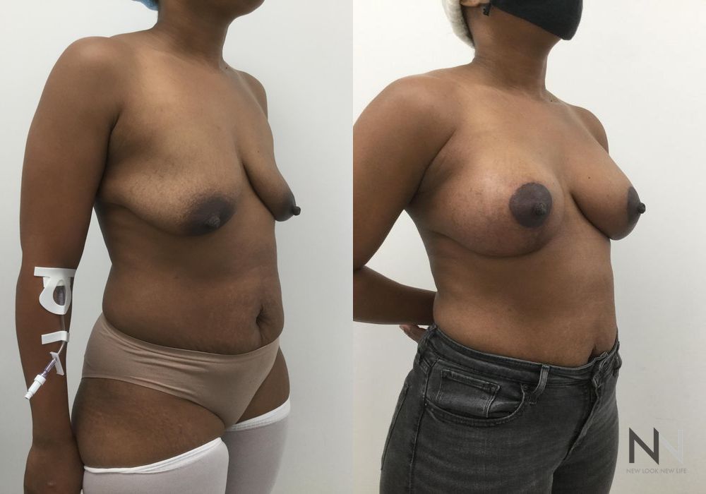 Breast Augmentation - Case 1826