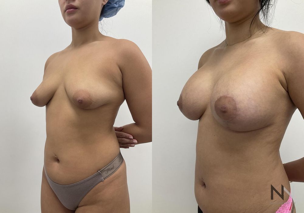 Breast Augmentation - Thumbnail 7