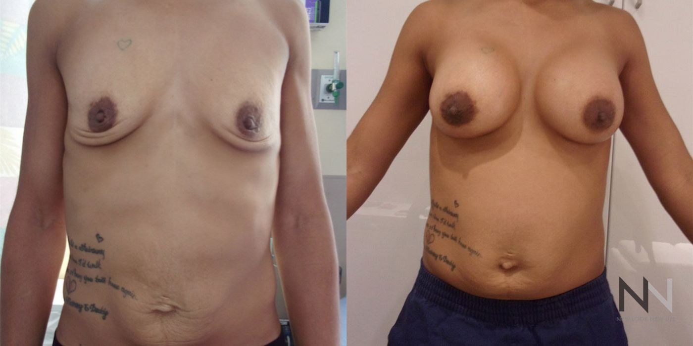 Before and after Breast Augmentation case 21249