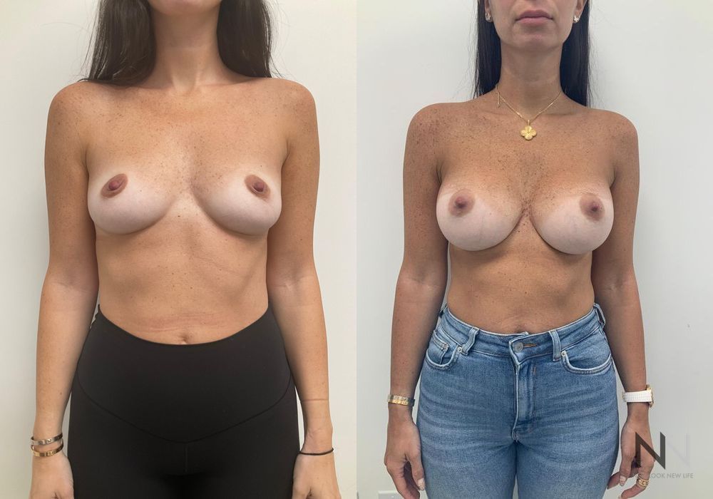 Breast Augmentation - Case 1824