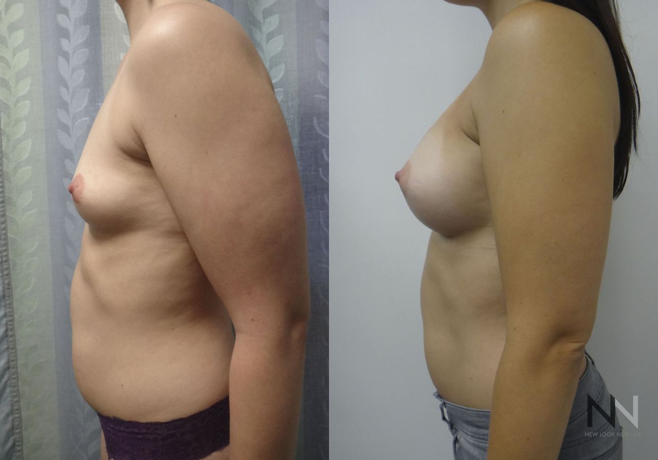 Breast augmentation before and after symmetry improvement - Angle 5