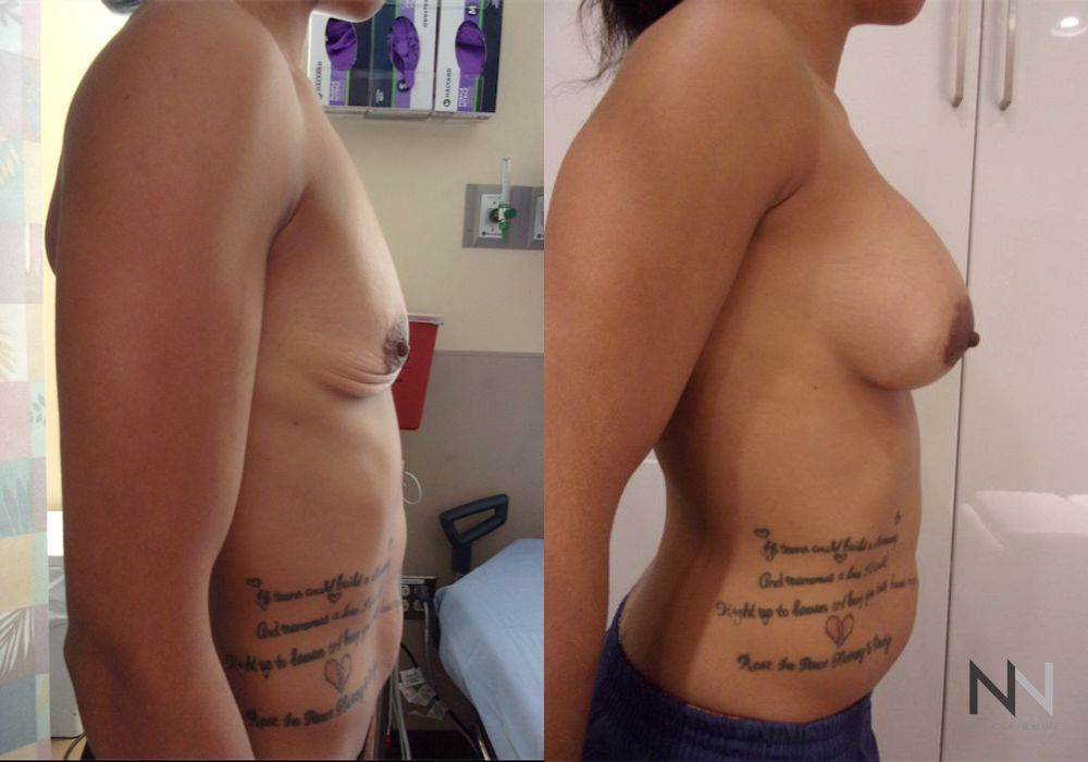 Breast Augmentation - Case 1819