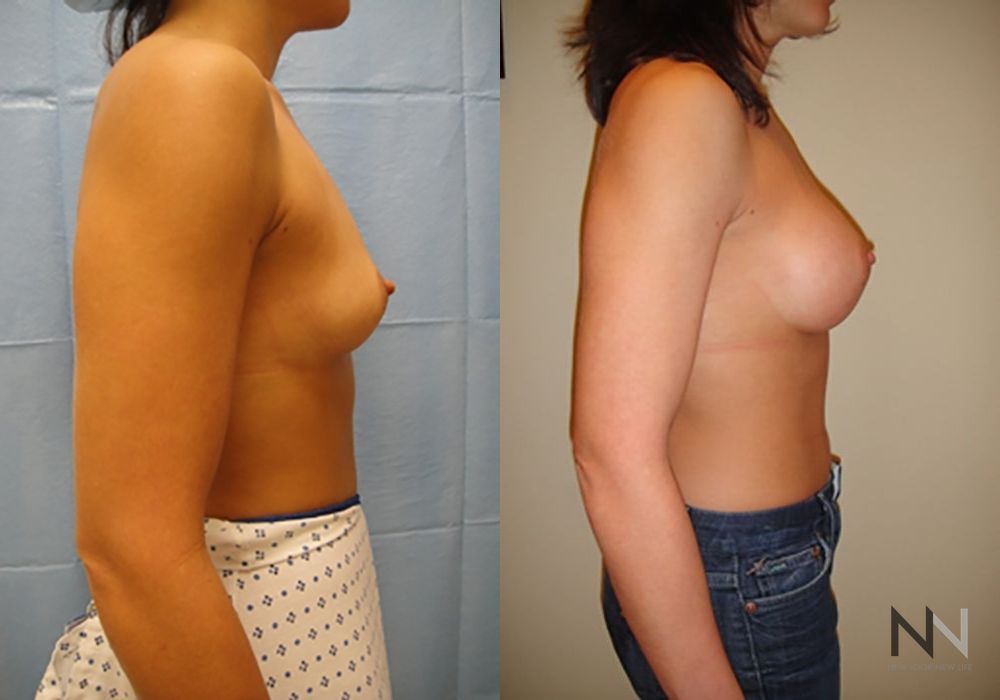 Breast Augmentation - Thumbnail 3