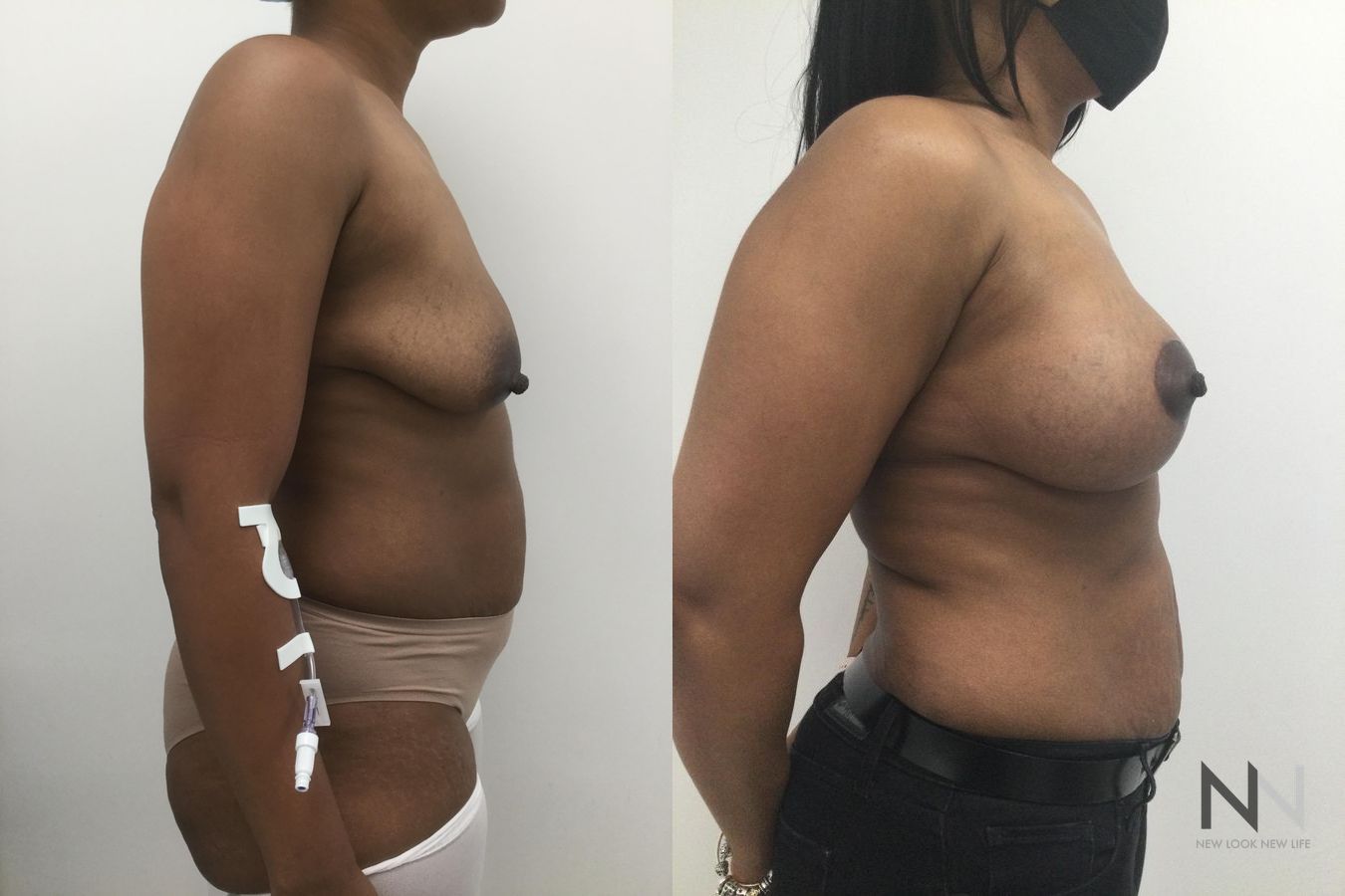 Breast augmentation before and after symmetry improvement - Angle 2