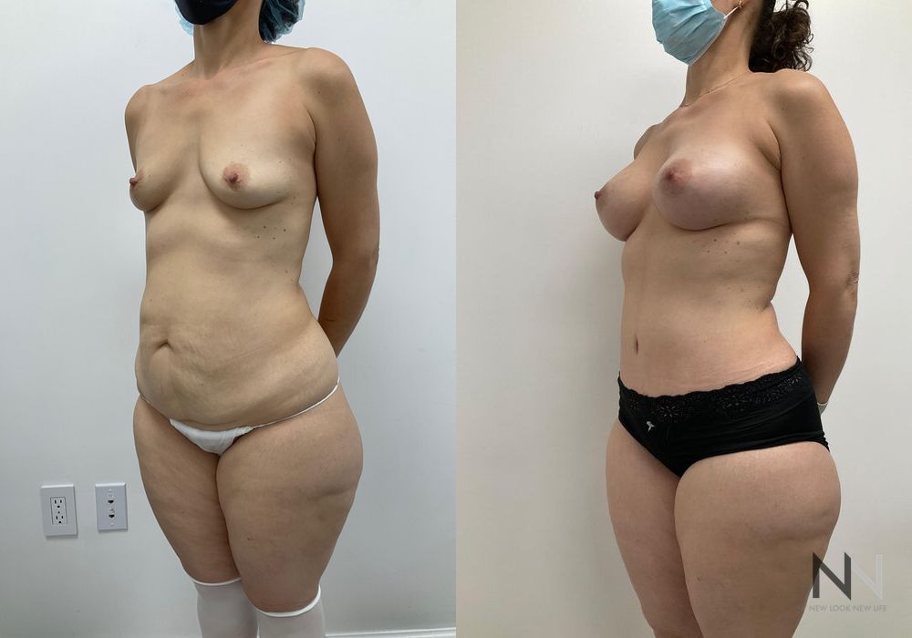 Breast Augmentation - Thumbnail 3