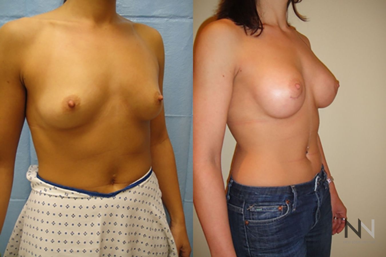 Breast contour enhancement six months post-op - Angle 4