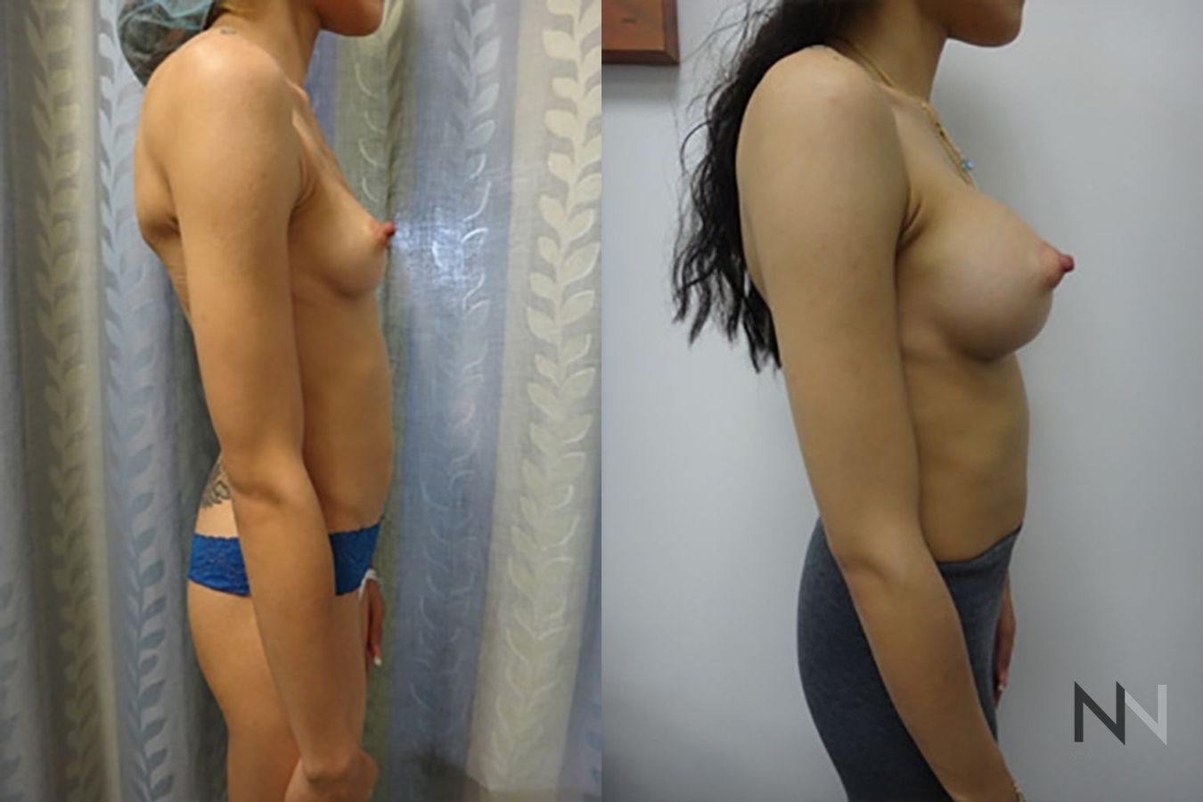 Before and after breast augmentation six months results - Angle 5