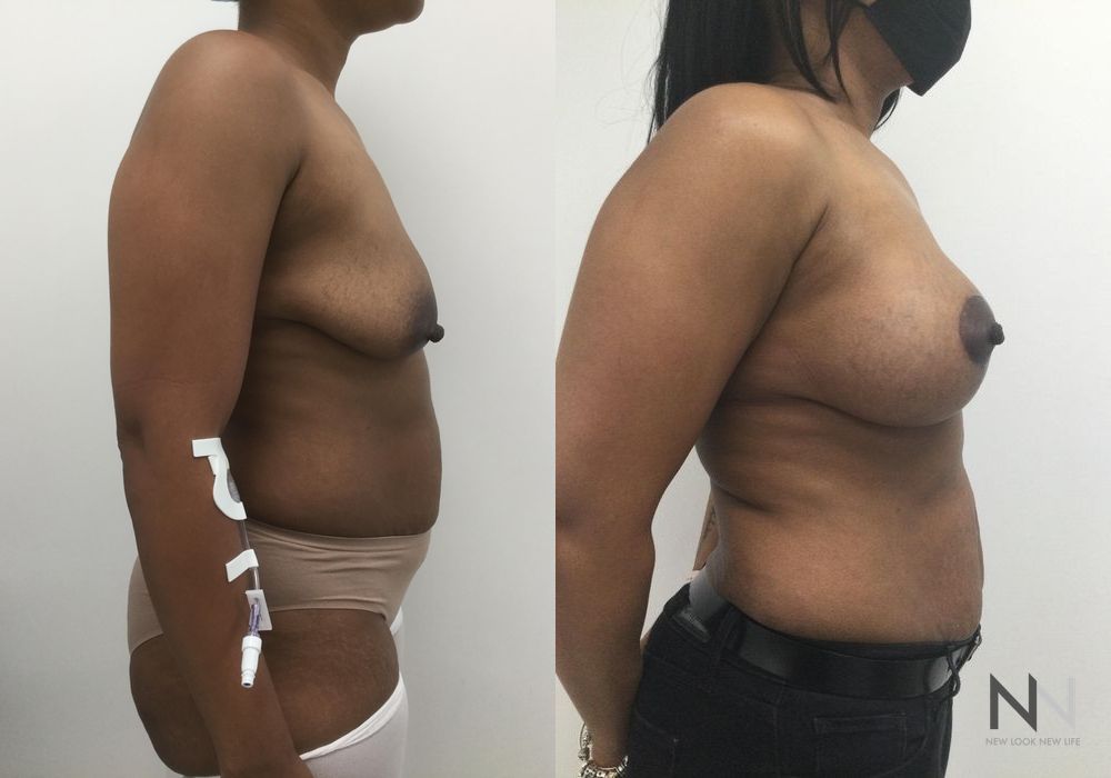 Breast Augmentation - Thumbnail 2