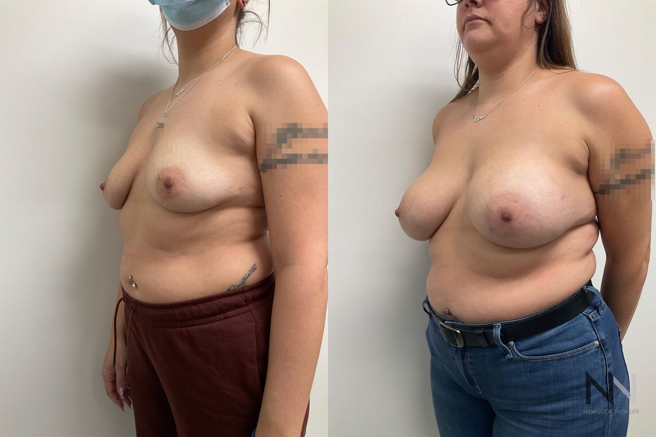 reast implants showing increased volume and projection - Angle 2