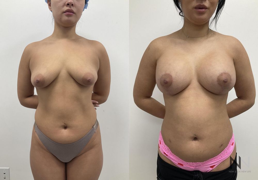 Breast Augmentation - Thumbnail 6