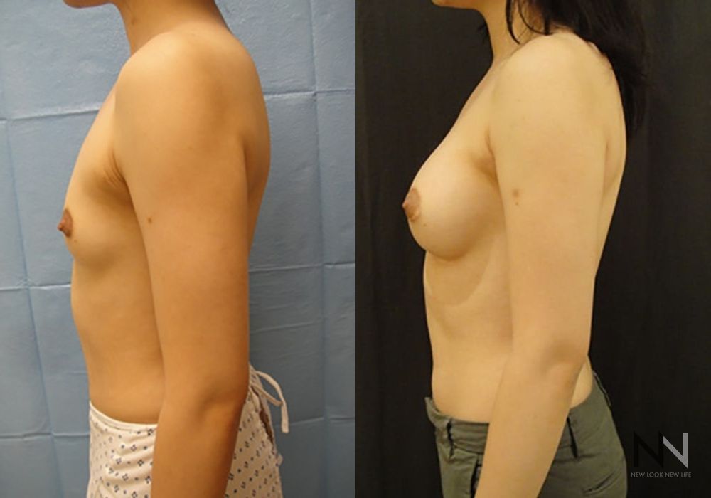 Breast Augmentation - Thumbnail 5