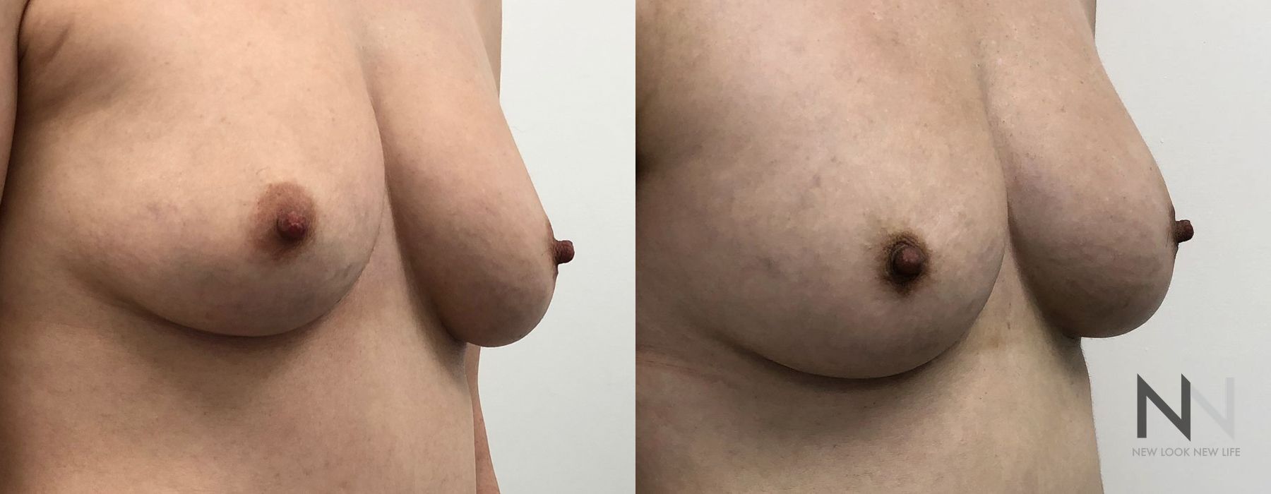 Breast Augmentation - Case 1829