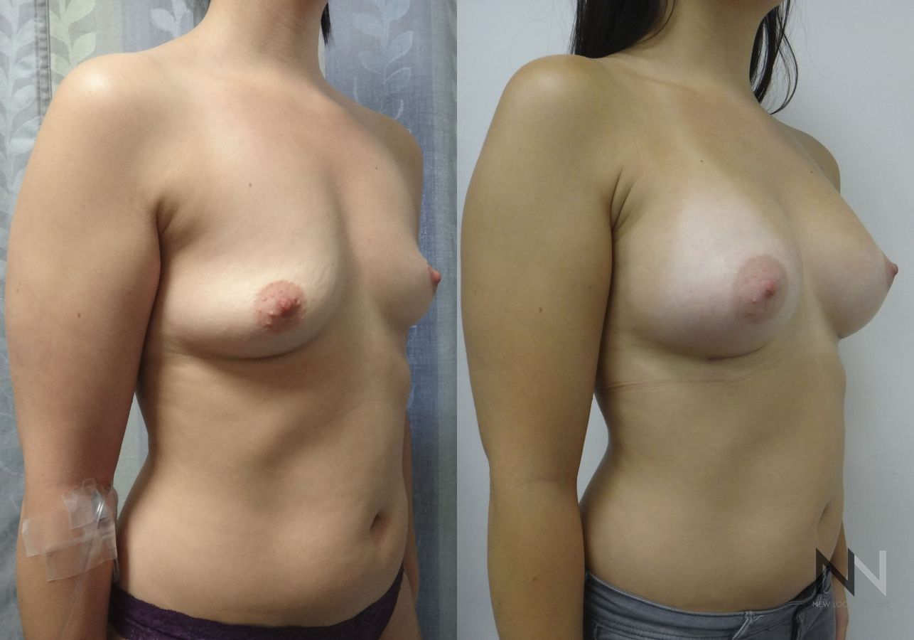 Breast augmentation before and after symmetry improvement - Angle 2