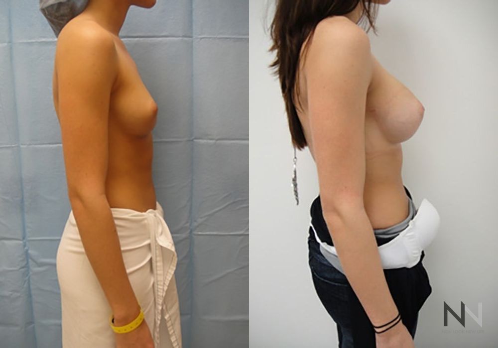 Breast Augmentation - Thumbnail 5