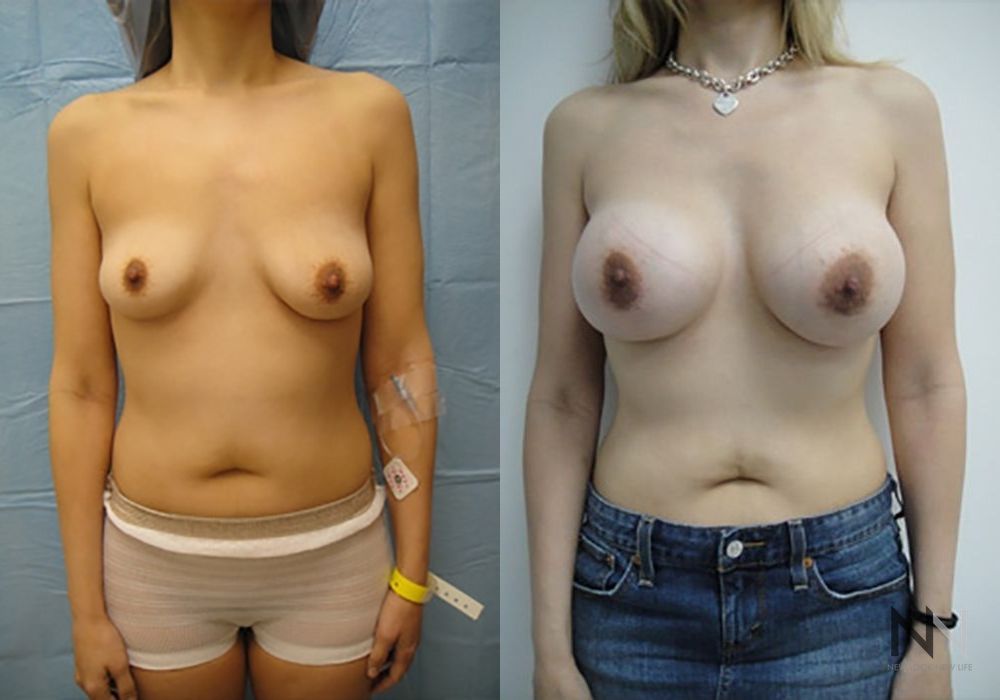 Breast Augmentation - Case 2001