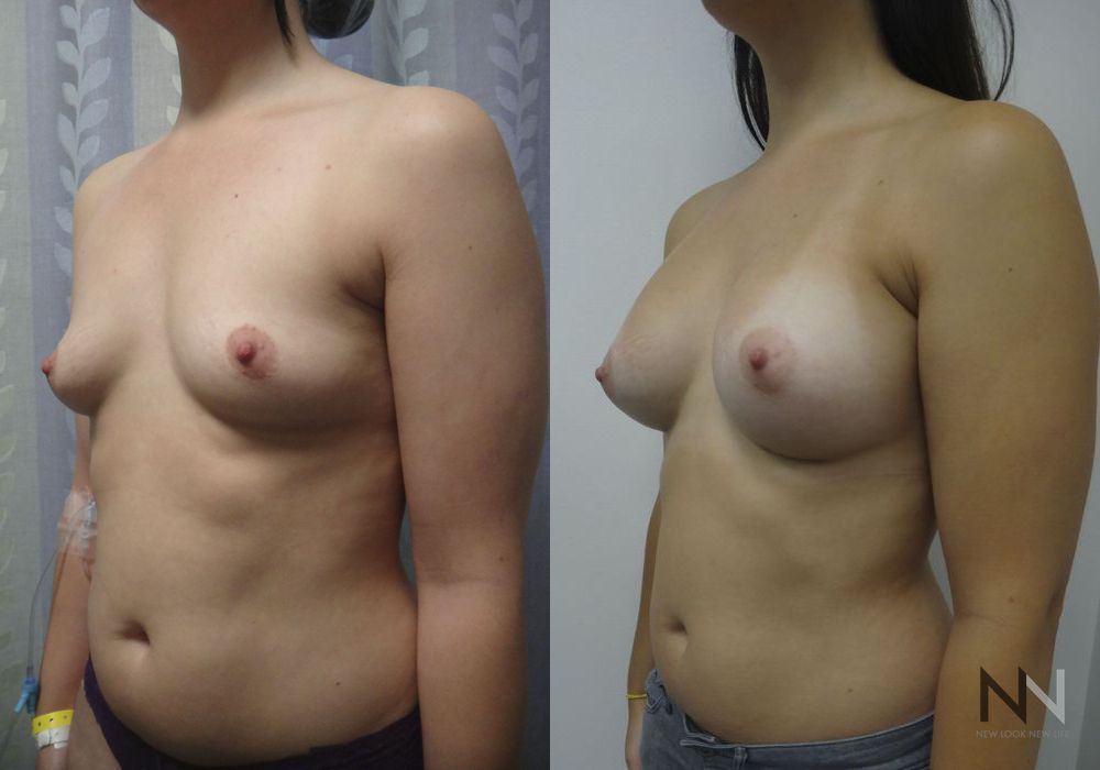Breast Augmentation - Thumbnail 4
