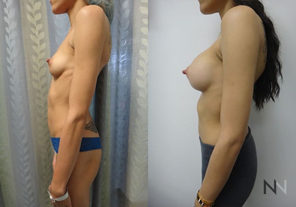 Breast Augmentation - Thumbnail 3