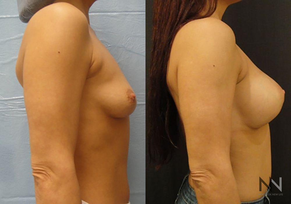 Breast Augmentation - Thumbnail 5