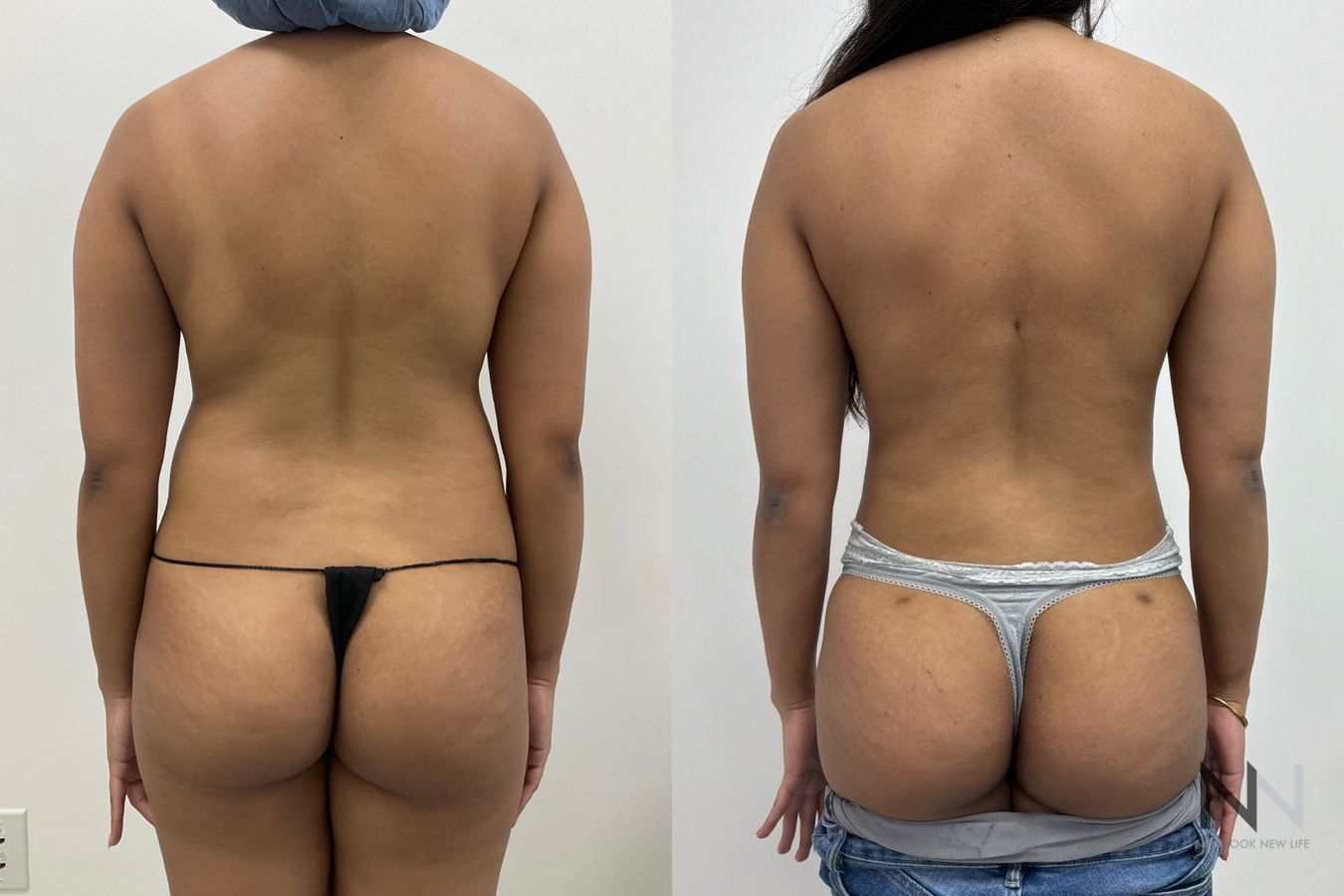 Before-and-after images of Liposuction 360 by Dr. Claudia Kim, showcasing contouring of the abdomen, flanks, back, and underarm areas for a more defined silhouette. - Angle 3
