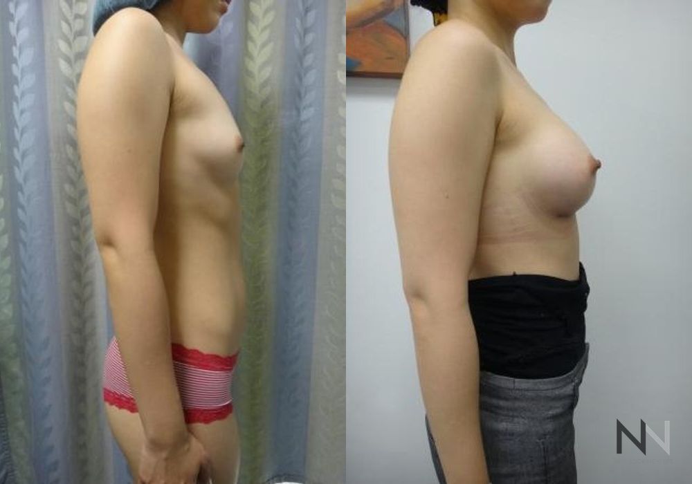 Breast Augmentation - Thumbnail 3