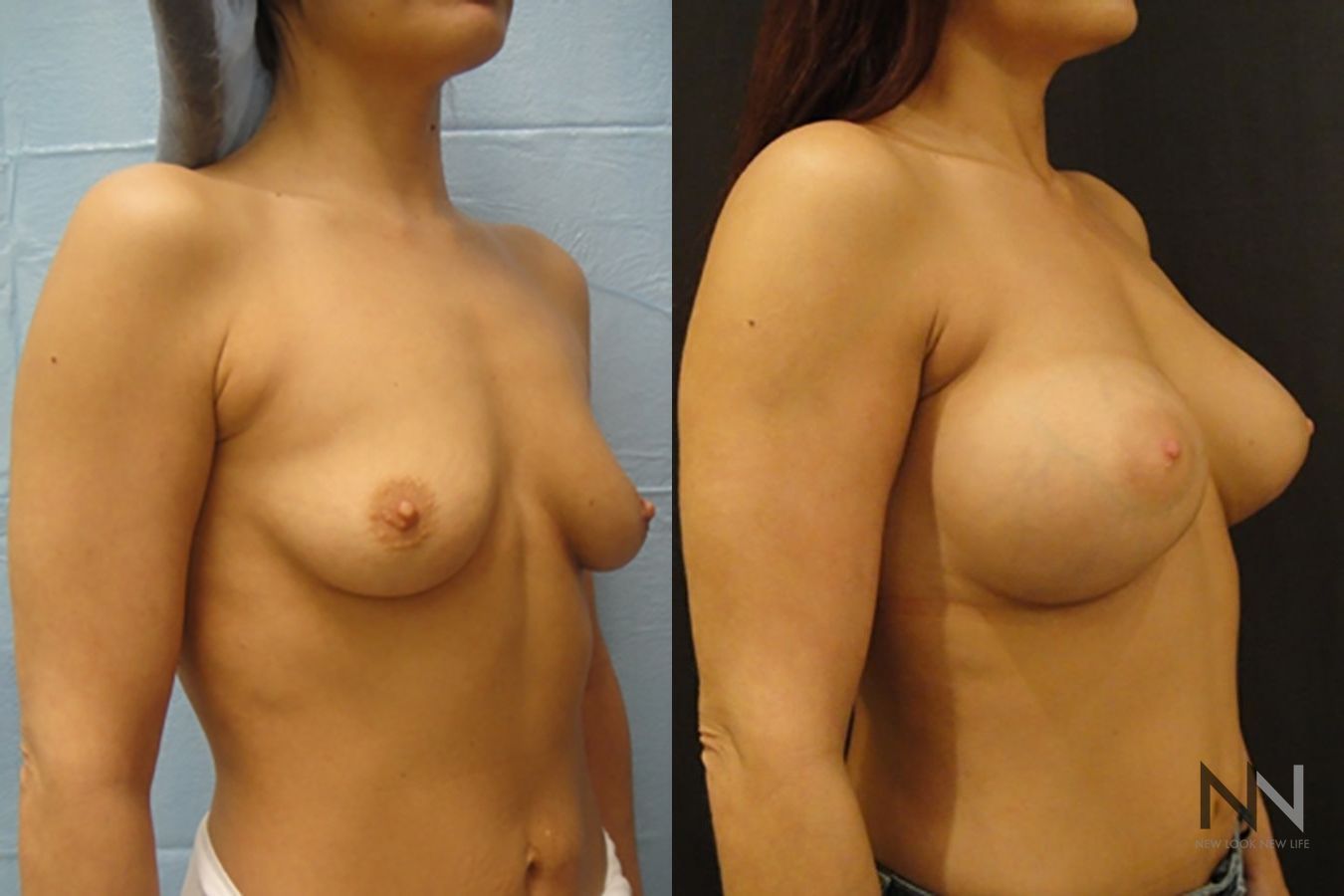 Breast augmentation before and after symmetry improvement - Angle 4