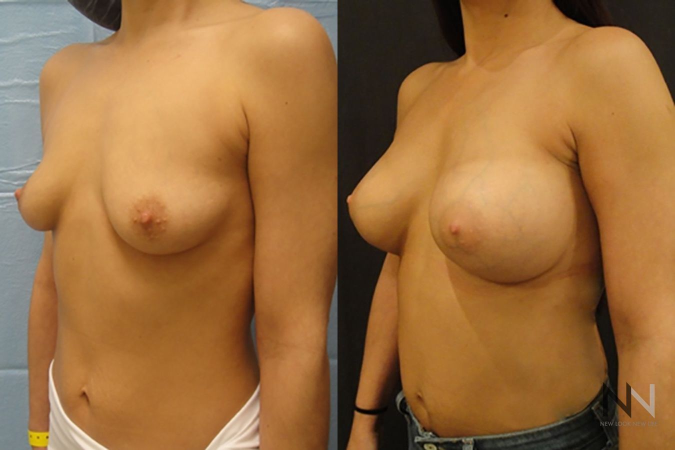 Breast augmentation before and after symmetry improvement - Angle 2