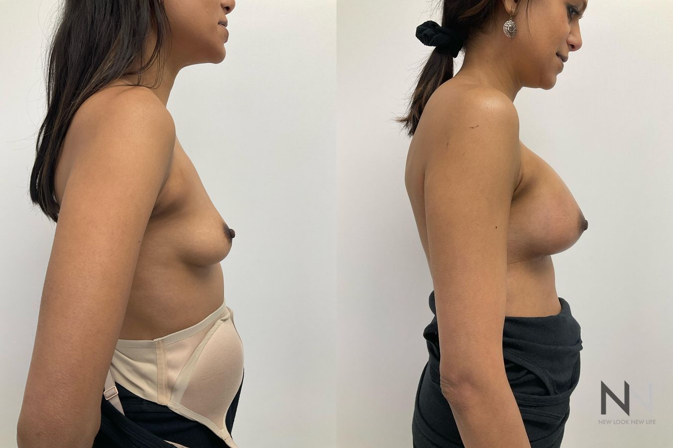 Breast augmentation before and after symmetry improvement - Angle 3