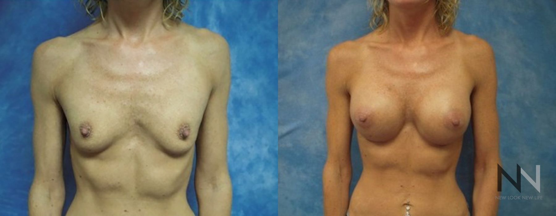 Breast Augmentation - Thumbnail 2