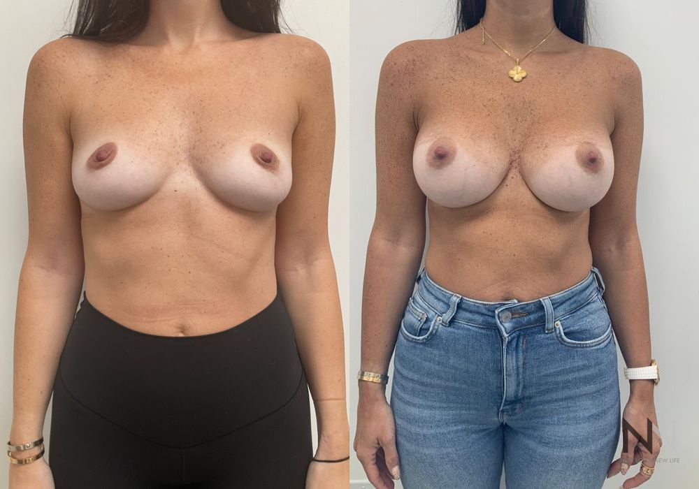 Breast Augmentation - Case 2010