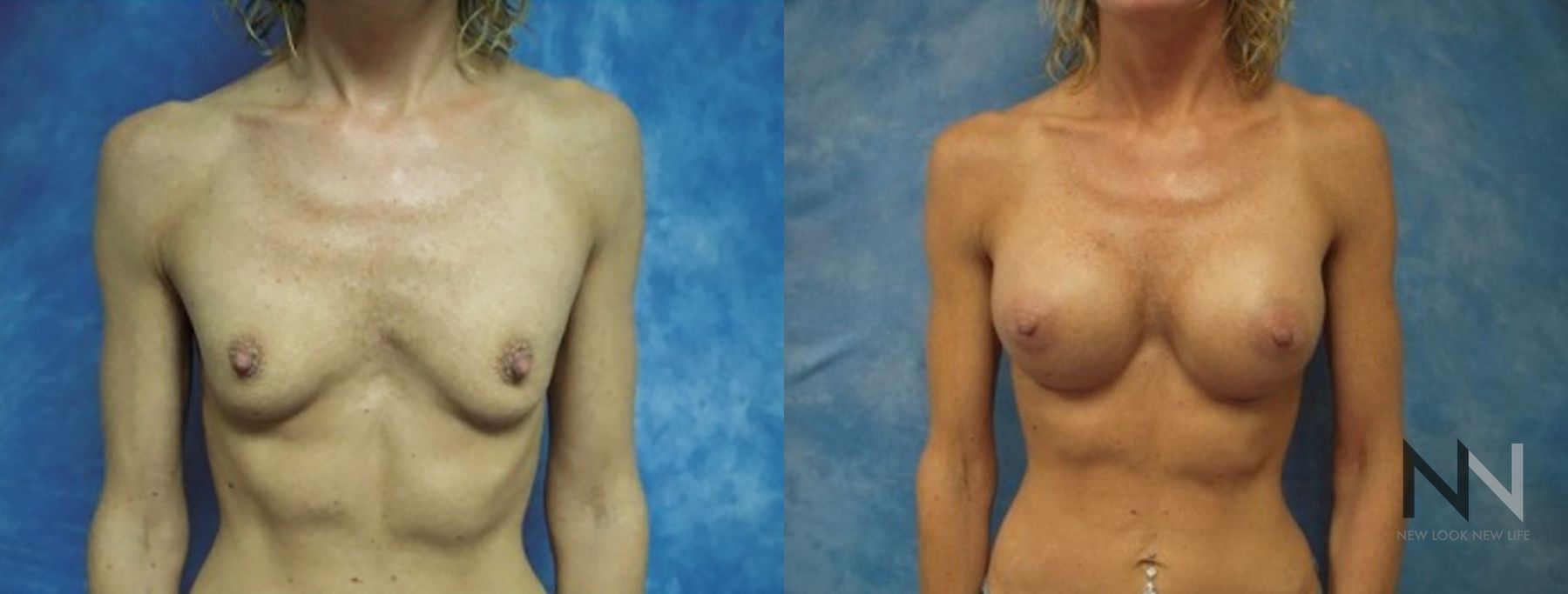 Breast augmentation before and after symmetry improvement