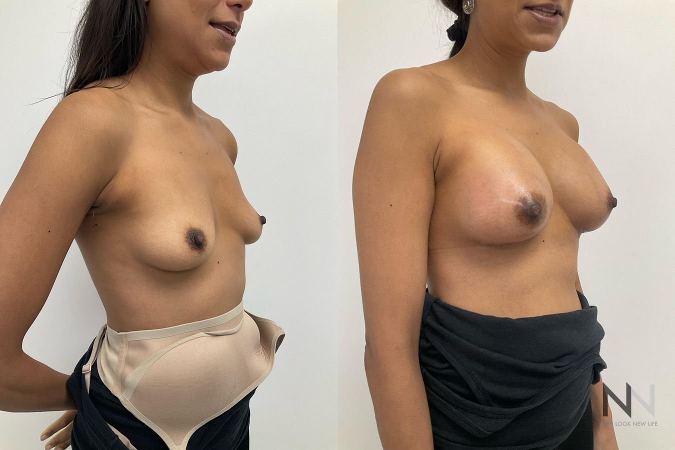 Breast augmentation before and after symmetry improvement - Angle 2