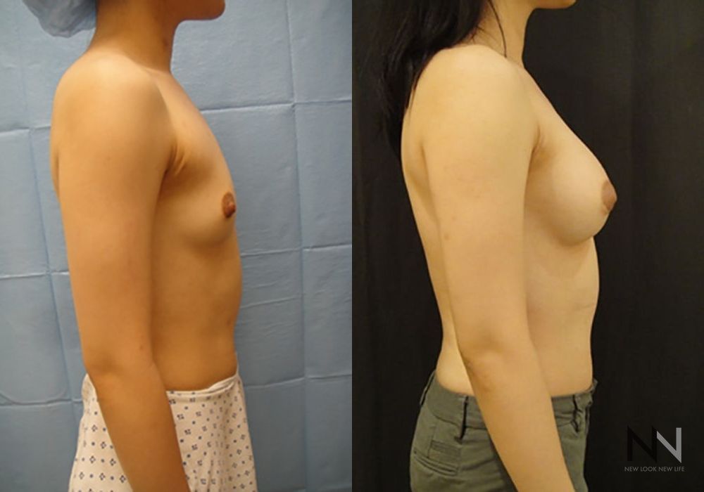 Breast Augmentation - Thumbnail 4