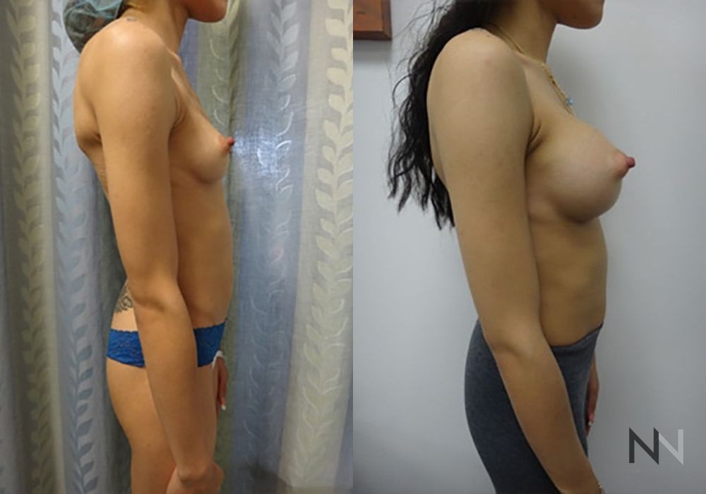 Breast Augmentation - Thumbnail 5