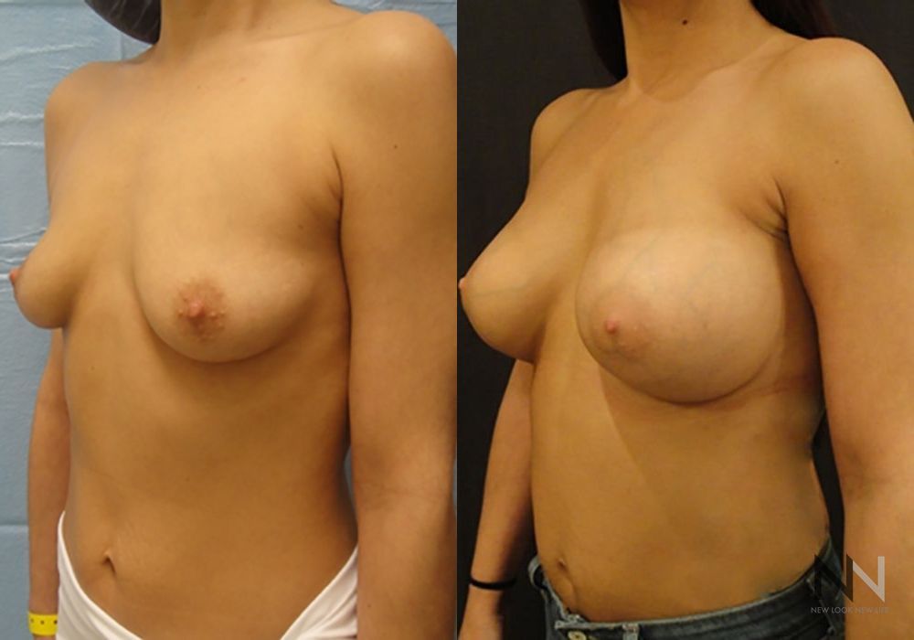 Breast Augmentation - Thumbnail 2
