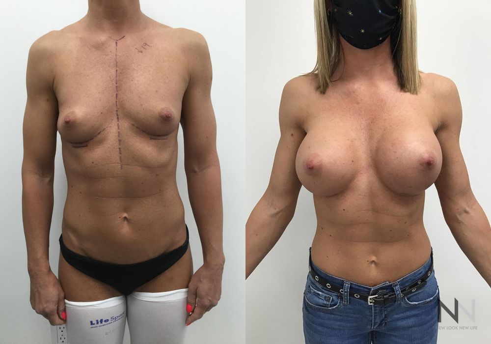 Breast Augmentation - Case 2011