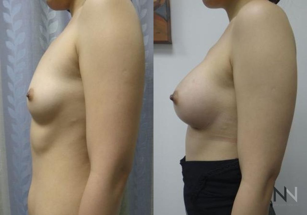 Breast Augmentation - Thumbnail 5