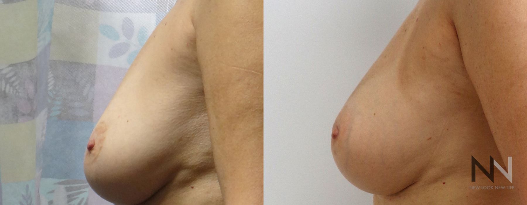 Breast Augmentation - Thumbnail 2